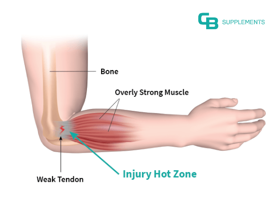 Injury Hot Zone with Overly Strong Muscle and Weak Tendon Illustration